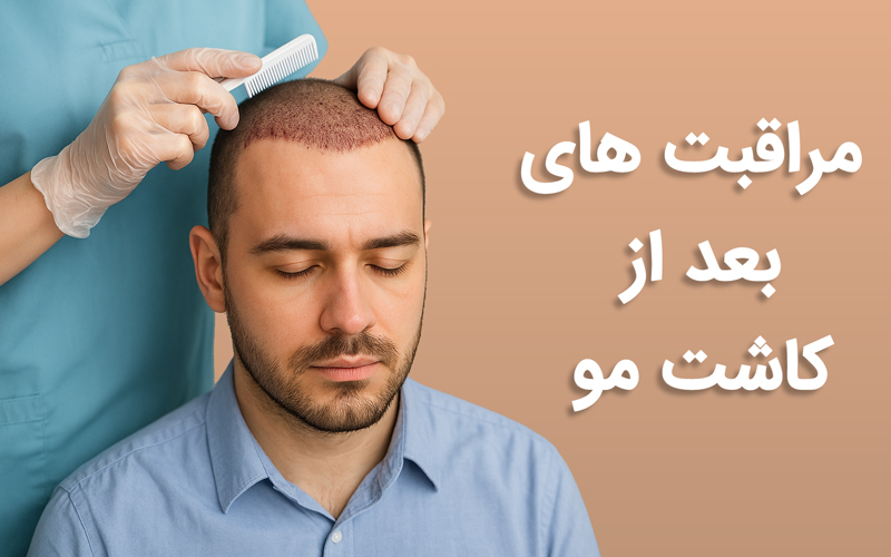 مراقبتهای بعد از کاشت مو