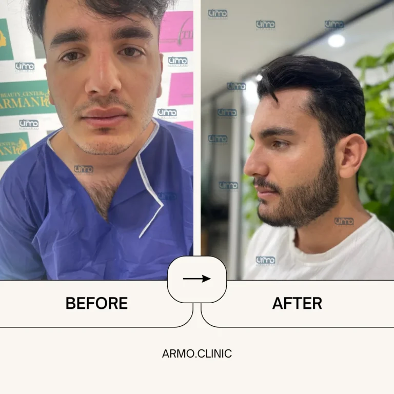 نمونه کاشت ریش۳