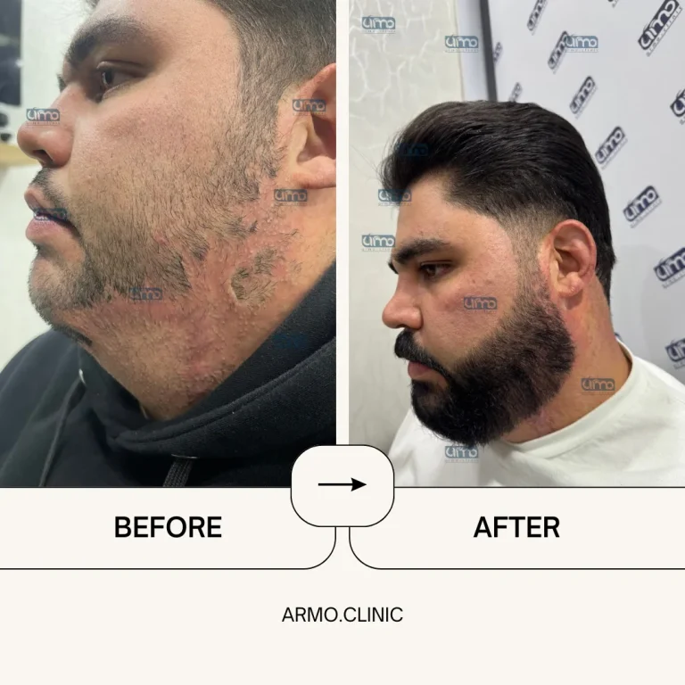 نمونه کاشت ریش ۲