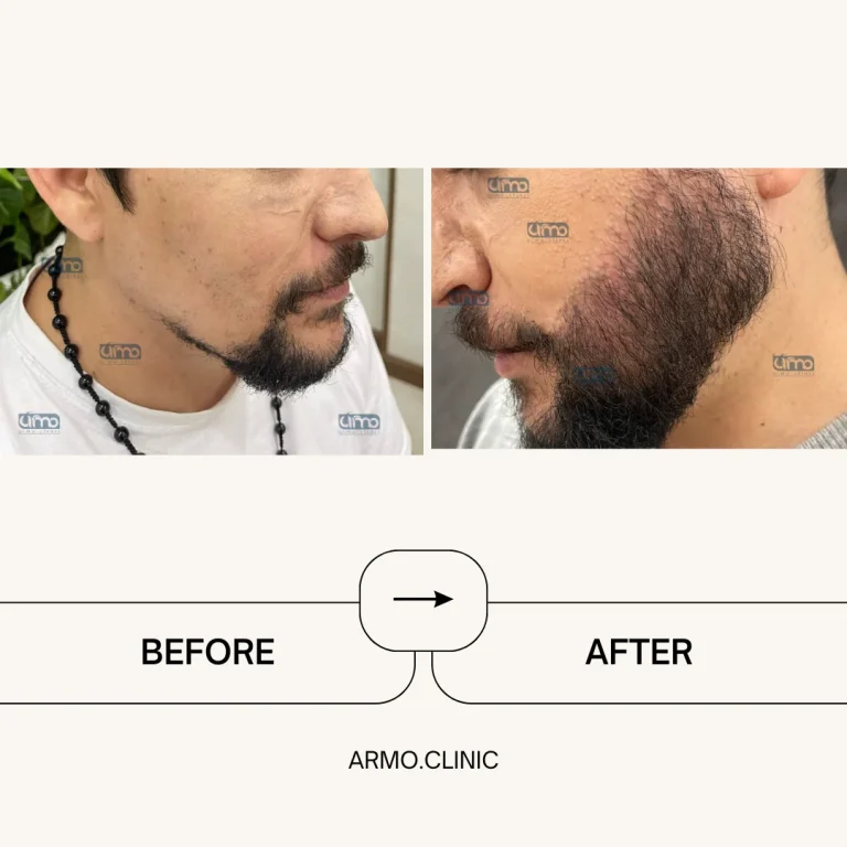 نمونه کاشت ریش ۱