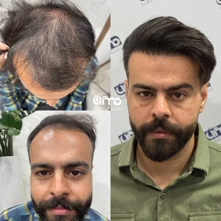 نمونه کار کاشت مو در کلینیک آرمو ۱۱