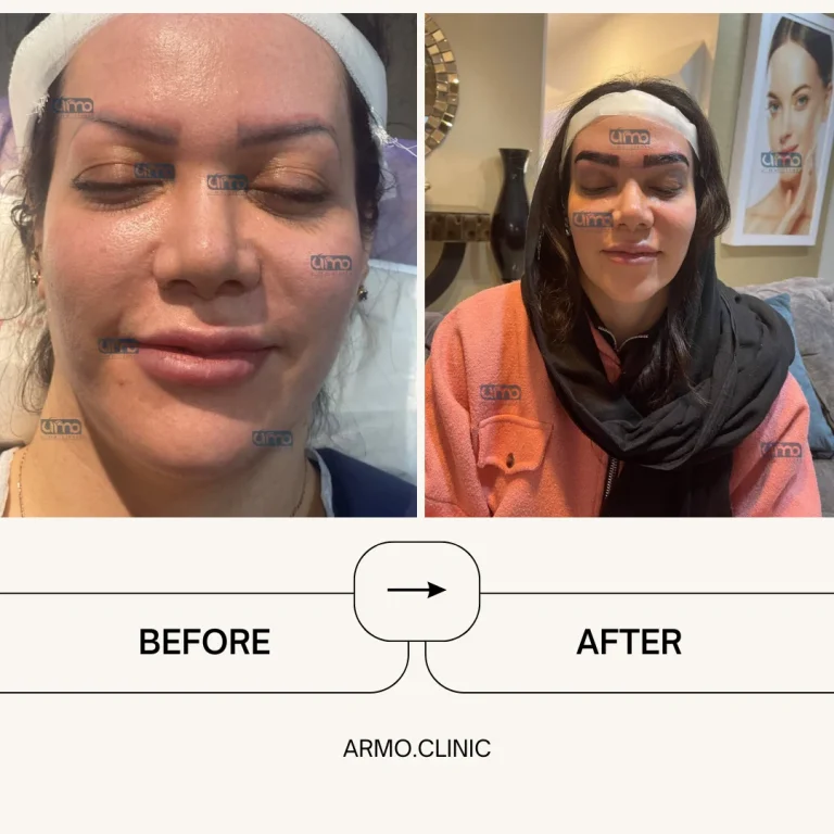 کاشت ابرو 4 قیمت کاشت مو برای خانم ها