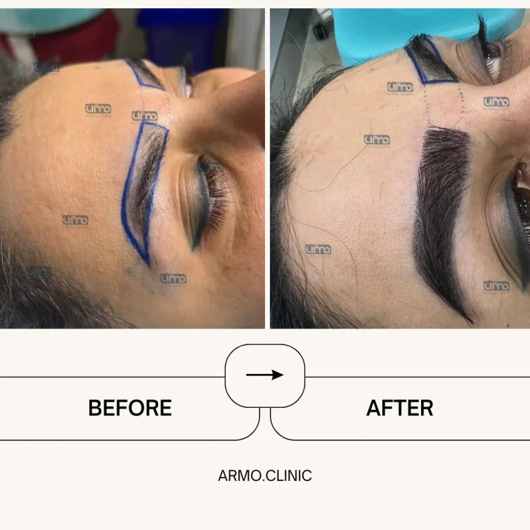 کاشت ابرو 2 کلینیک کاشت ابرو در قزوین