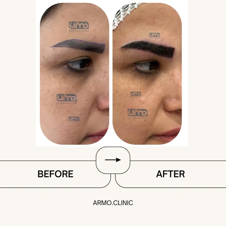 کاشت ابرو 5 نمونه کار کاشت ابرو۲