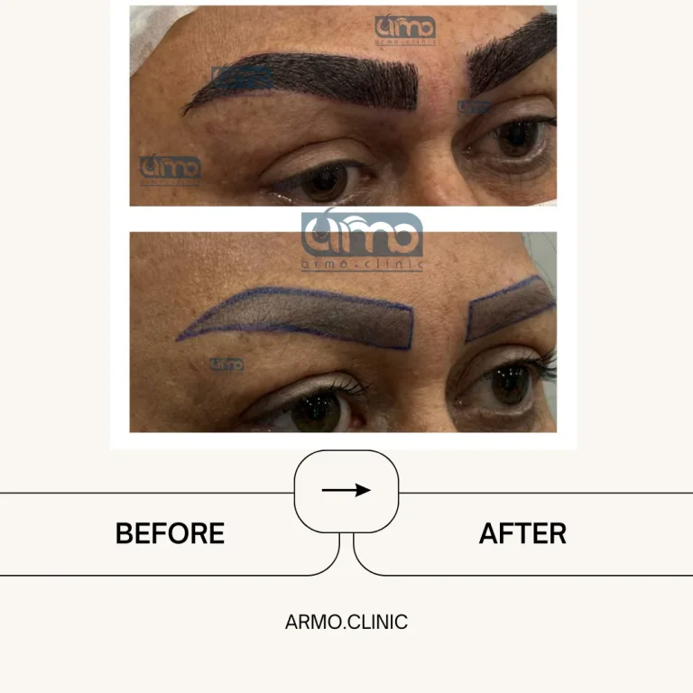 کاشت ابرو 6 نمونه کار کاشت ابرو ۳