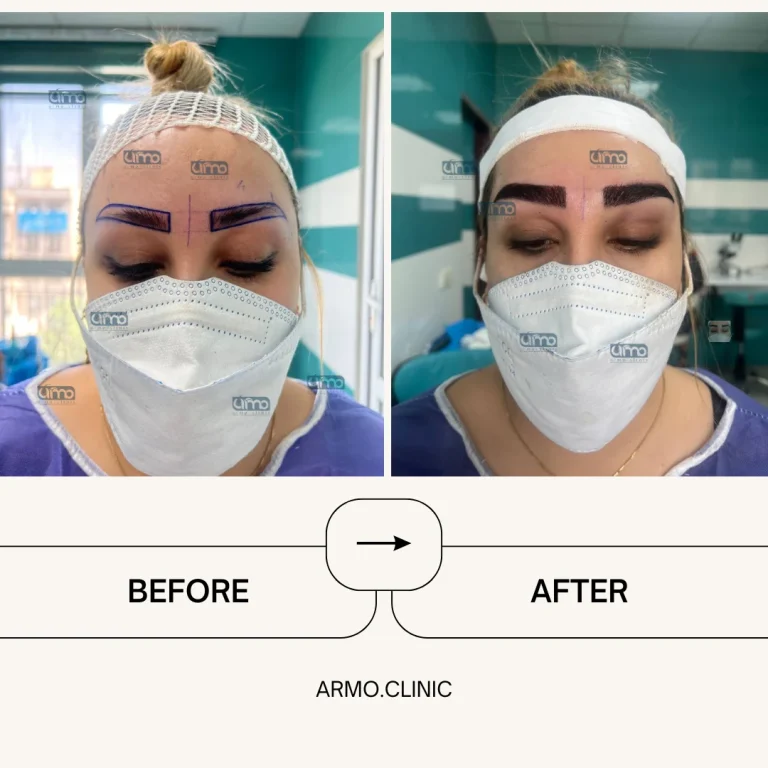 کاشت ابرو 3 نمونه کار کاشت ابرو۱