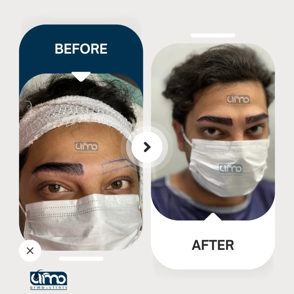 کاشت ابرو 7 نمونه کار کاشت ابرو