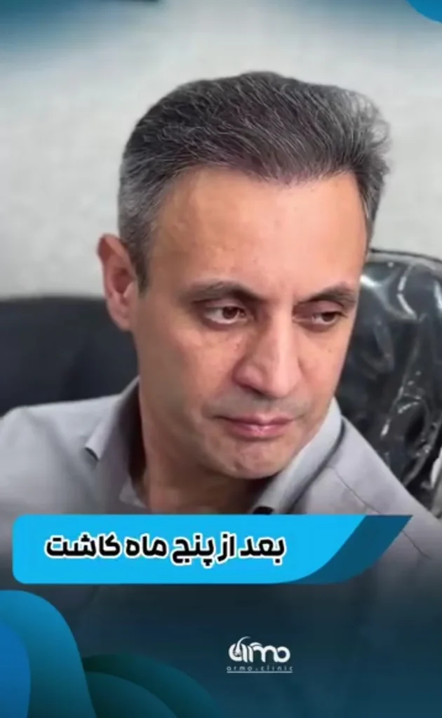 عکس نمونه کاشت بعد از ۵ ماه