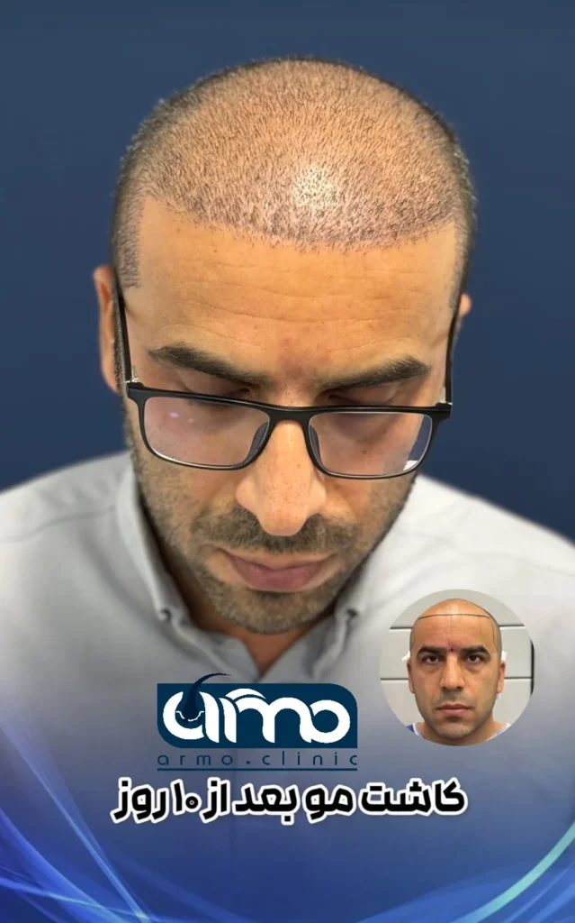 عکس نمونه کاشت بعد از ۱۰ روز 