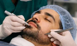 یه مرد که مشغول کاشت ریش می باشد