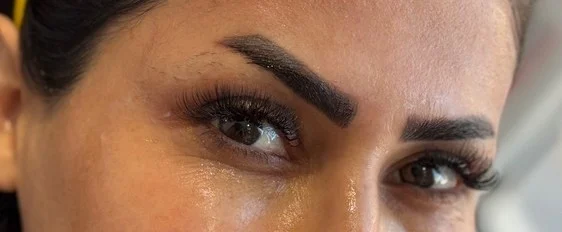 بعد از تزریق بوتاکس اطراف چشم (پنجه کلاغی)