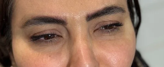بعد از تزریق بوتاکس خط اخم و پیشانی