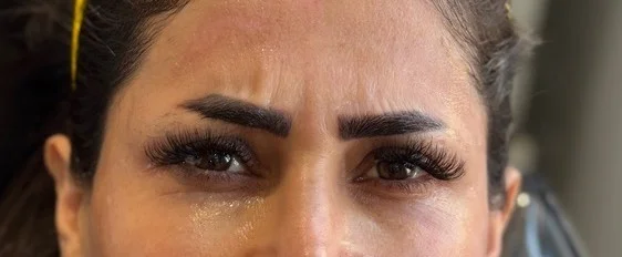قبل از تزریق بوتاکس اطراف چشم