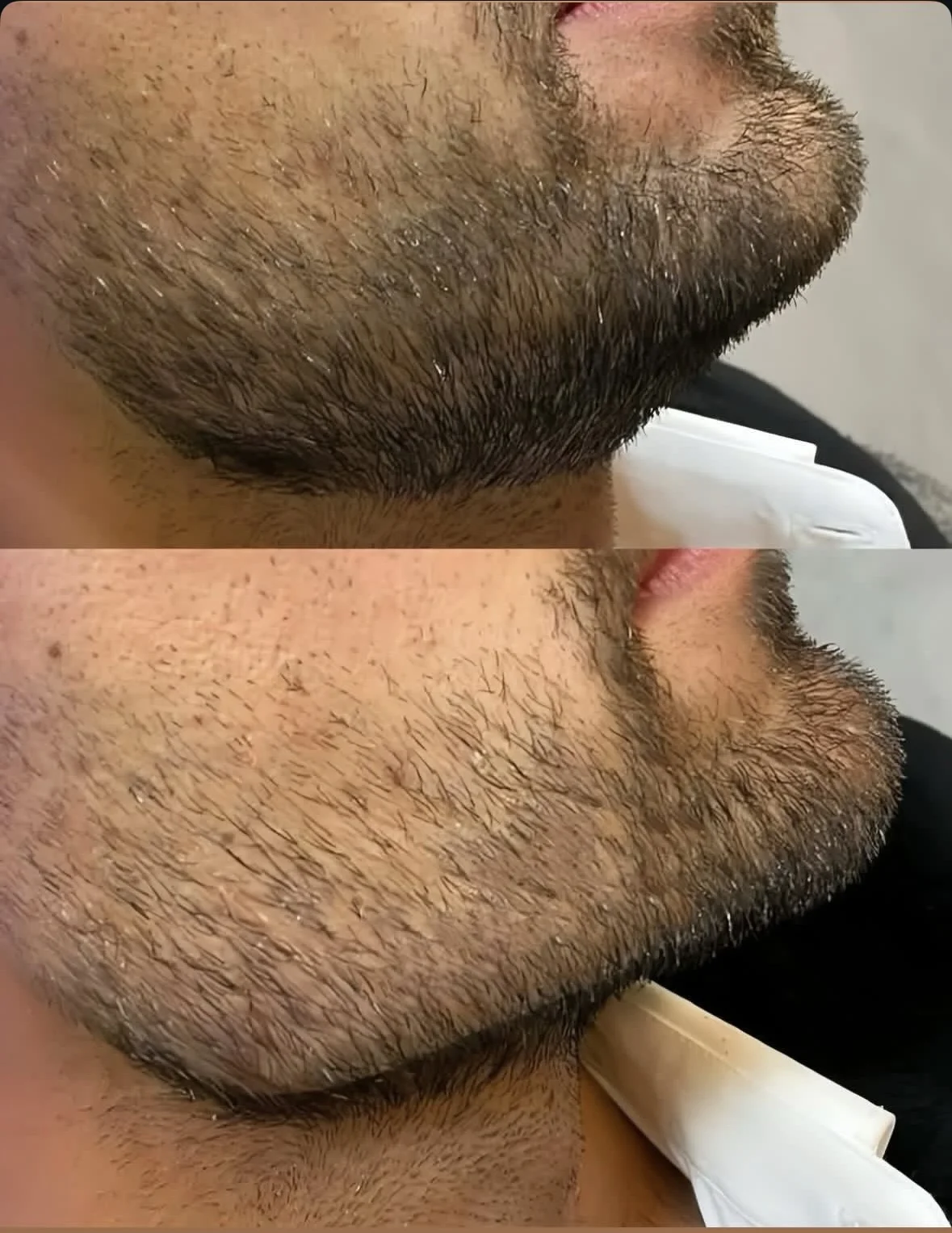 نمونه کار تزریق فیلر زاویه فک در کلینیک آرمو قزوین
