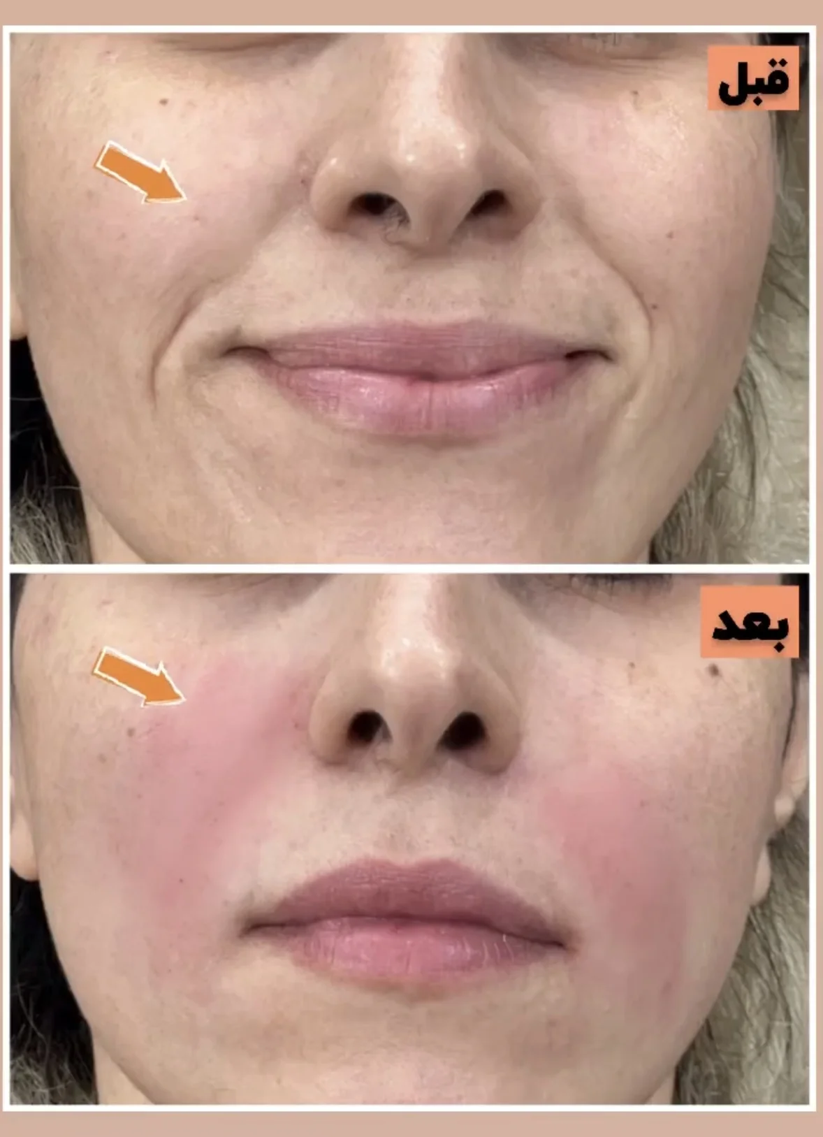 فیلر خط لبخند 3 نمونه کار تزریق فیلر خط لبخند در کلینیک آرمو قزوین