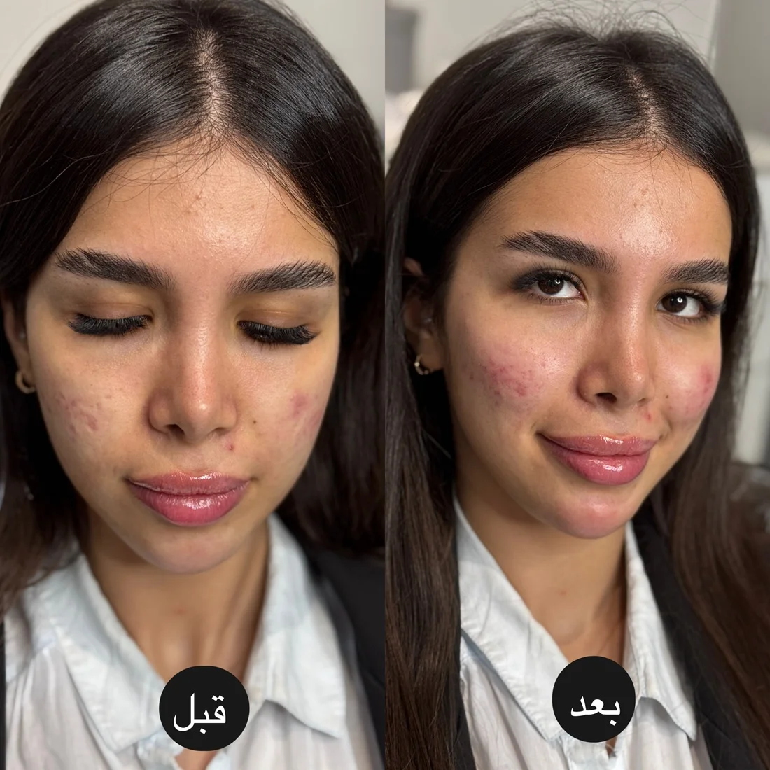 نمونه کار قبل و بعد فیلر گونه در کلینیک آرمو