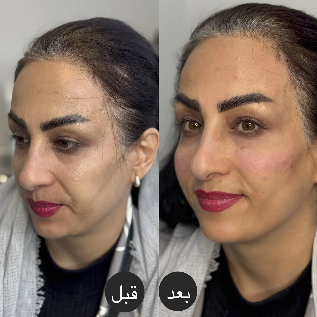 نمونه کار تزریق فیلر گونه در کلینیک آرمو قزوین