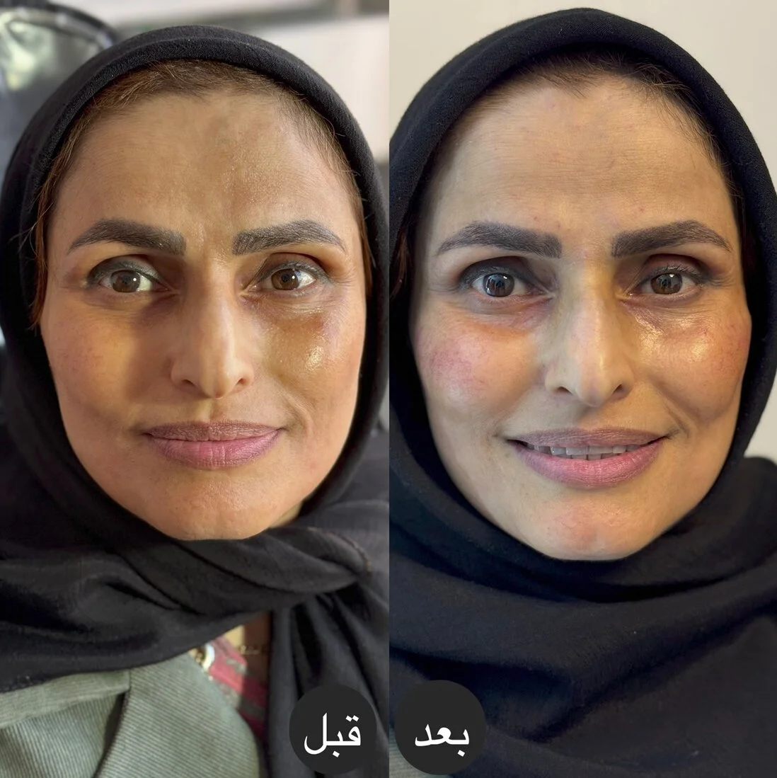 نمونه کار فیلر گونه طبیعی در کلینیک آرمو قزوین