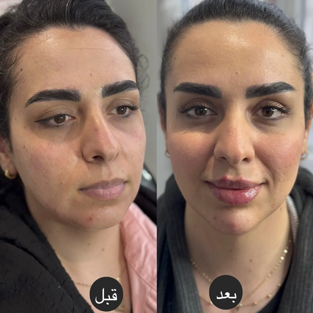 تزریق فیلر فول فیس